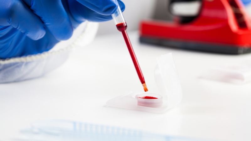 Kap krvi iz epruvete nanosi se na laboratorijski test za CRP analizu