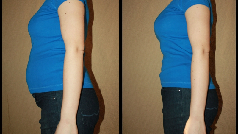 Uporedni prikaz tela pre i posle smanjenja zadržavanja vode