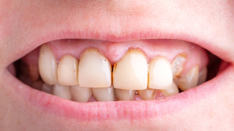 Vidljive naslage kamenca i mrlja uz ivicu desni na prednjim zubima