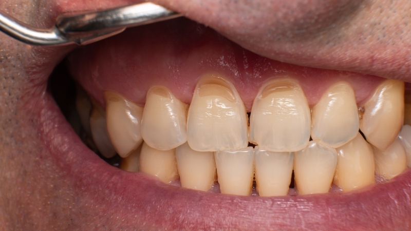 Naslage kamenca duž linije desni vidljive tokom stomatološkog pregleda